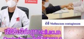 តើជំងឺសើរស្បែក Molluscum Contagiosum ជាជំងឺឆ្លងរឺទេ?